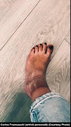 La o lună de la mușcătură, Corina a observat că glezna de la piciorul stâng s-a umflat și s-a învinețit.