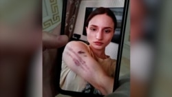 Фотография Айшат Баймурадовой со следами домашнего насилия